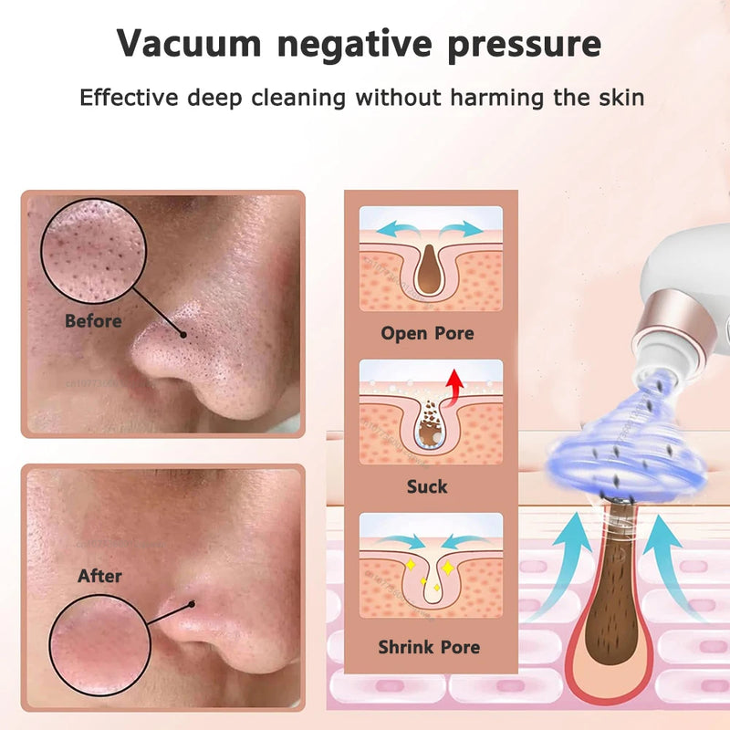 Remover Pore Vacuum Face Cleaner